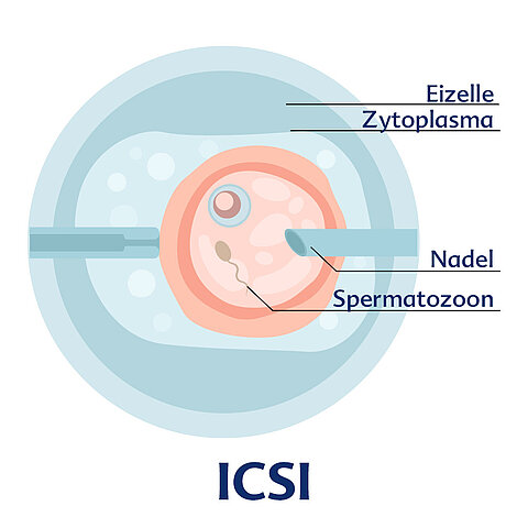 Die innere Struktur eines Embryos, wobei die Eizelle, das Zytoplasma, die Nadel und die Spermatozone hervorgehoben werden.